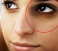 علت بوجود آمدن گودی زیر چشم چیست؟